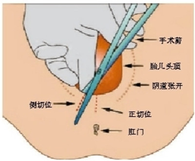 侧切是什么意思2