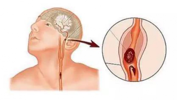 99%的血栓无征兆！记住一个字，让你远离这个游走血管的幽灵