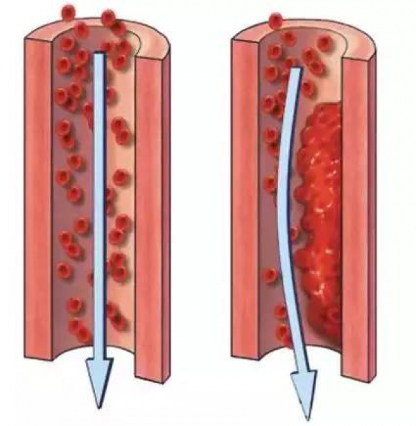 99%的血栓无征兆！记住一个字，让你远离这个游走血管的幽灵