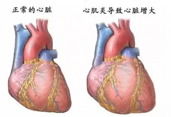 29岁年轻妈妈发病一周后死亡，这种病常盯上身体好压力大的青壮年